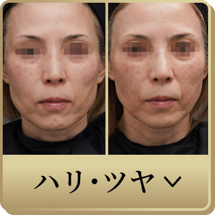 カスタムハリ・ツヤ治療