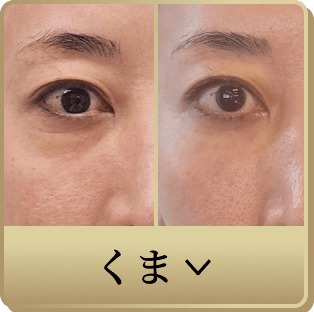 カスタムくま治療