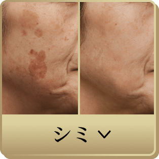 カスタムシミ治療