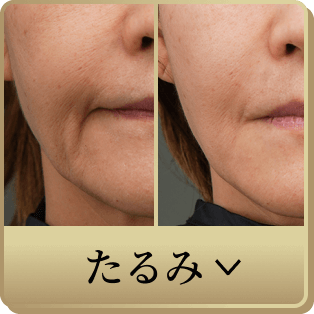 カスタムたるみ治療