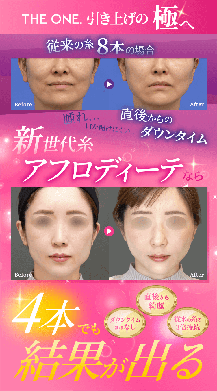 THE ONE.の最新糸リフト「アフロディーテ」