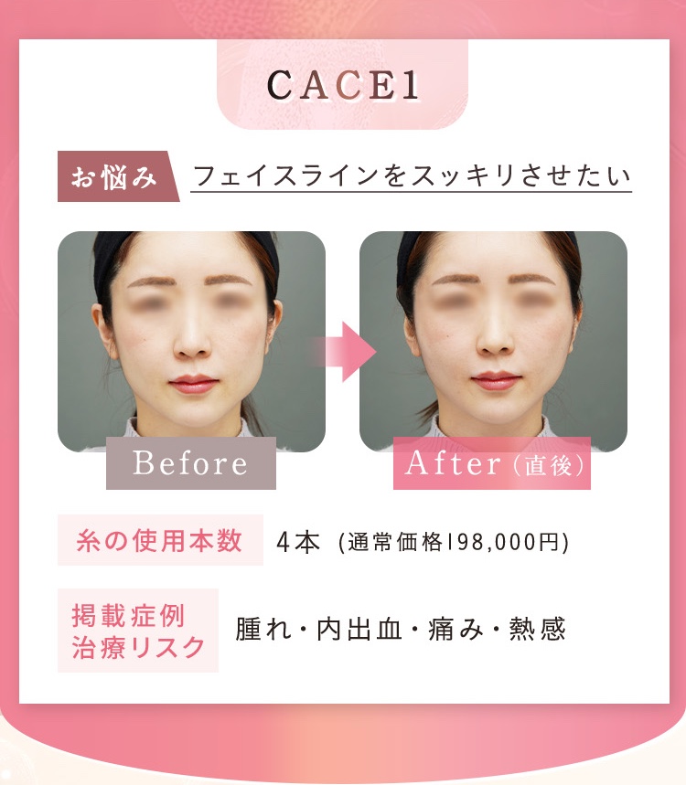 お悩み フェイスラインをスッキリさせたい