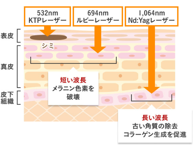 532nm KTPレーザー 694nm ルビーレーザー 1,064nm Nd:Yagレーザー 表皮 シミ 真皮 皮下組織 短い波長 メラニン色素を破壊 長い波長 古い角質の除去 コラーゲン生成を促進