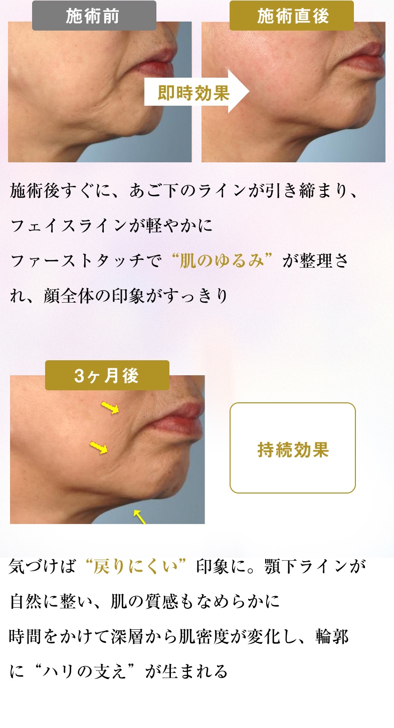 施術後すぐに、あご下のラインが引き締まり、フェイスラインが軽やかに ファーストタッチで「肌のゆるみ」が整理され、顔全体の印象がすっきり