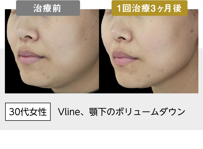 30代女性 Vline、顎下のボリュームダウン