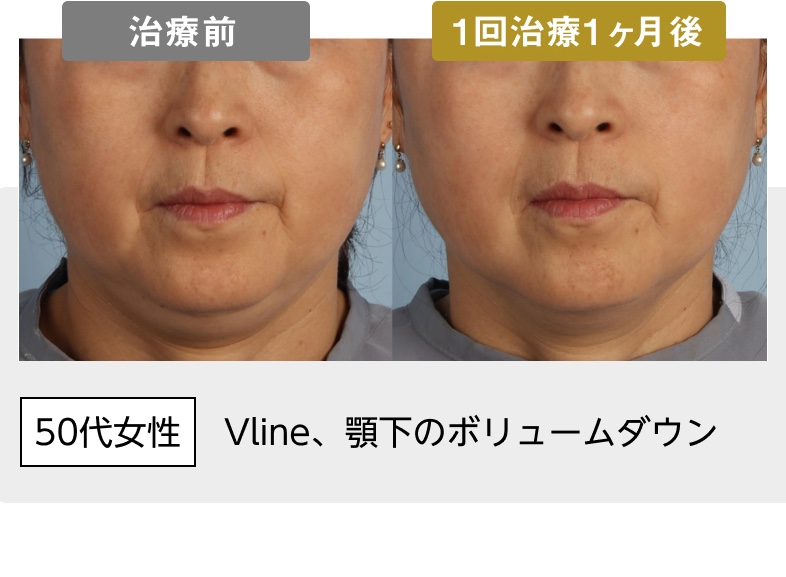 50代女性 Vline、顎下のボリュームダウン