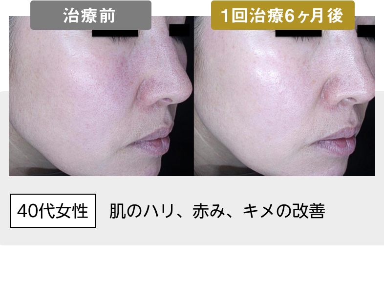 40代女性 肌のハリ、赤み、キメの改善