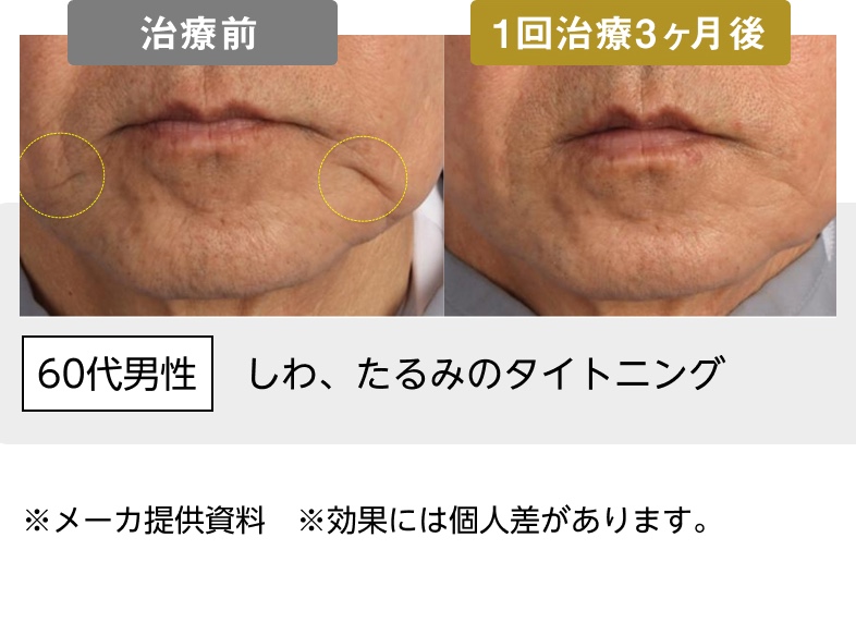 60代男性 しわ、たるみのタイトニング